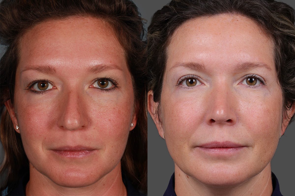 Eyelid Surgery (Blepharoplasty) Before & After Gallery - Patient 362020 - Image 1