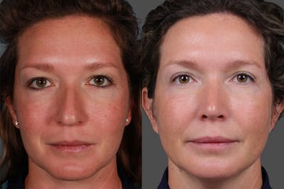 Eyelid Surgery (Blepharoplasty) Before & After Gallery - Patient 362020 - Image 1