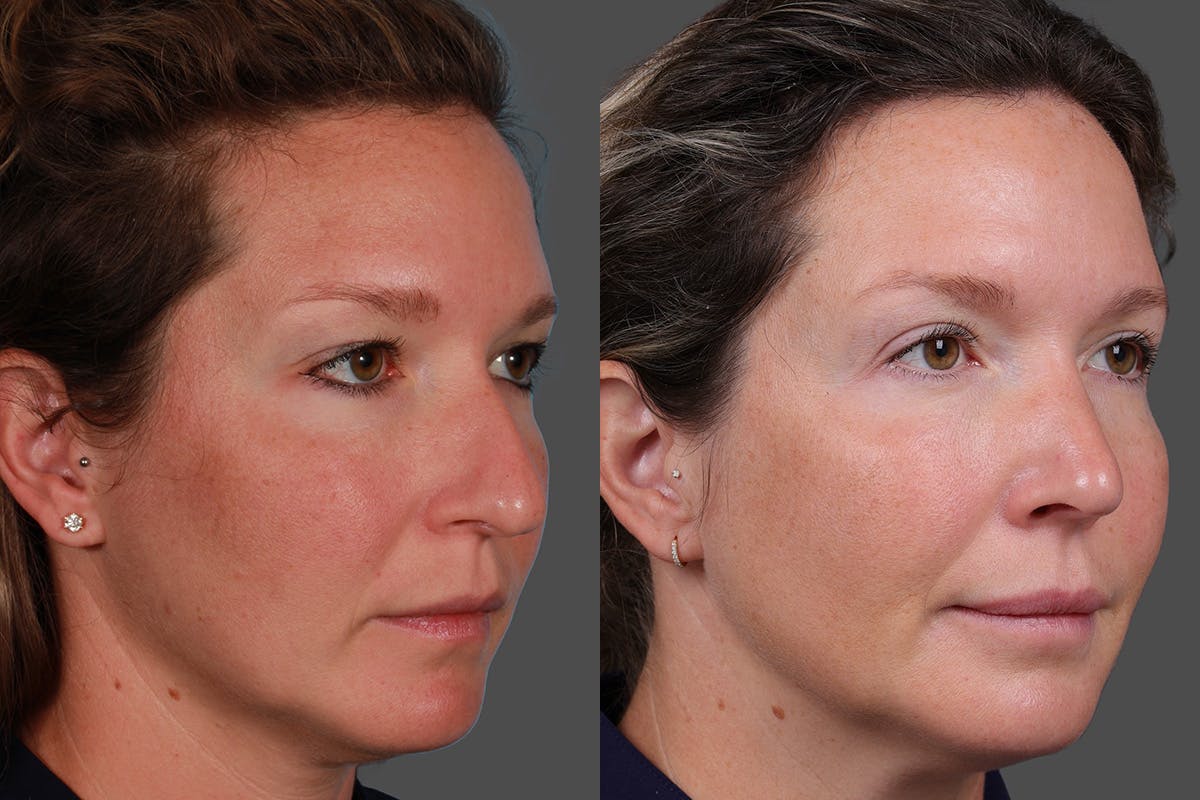 Eyelid Surgery (Blepharoplasty) Before & After Gallery - Patient 362020 - Image 2
