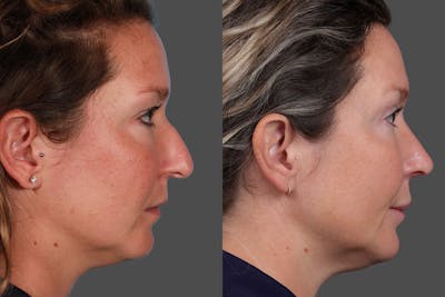 Rhinoplasty Before & After Gallery - Patient 368617 - Image 1