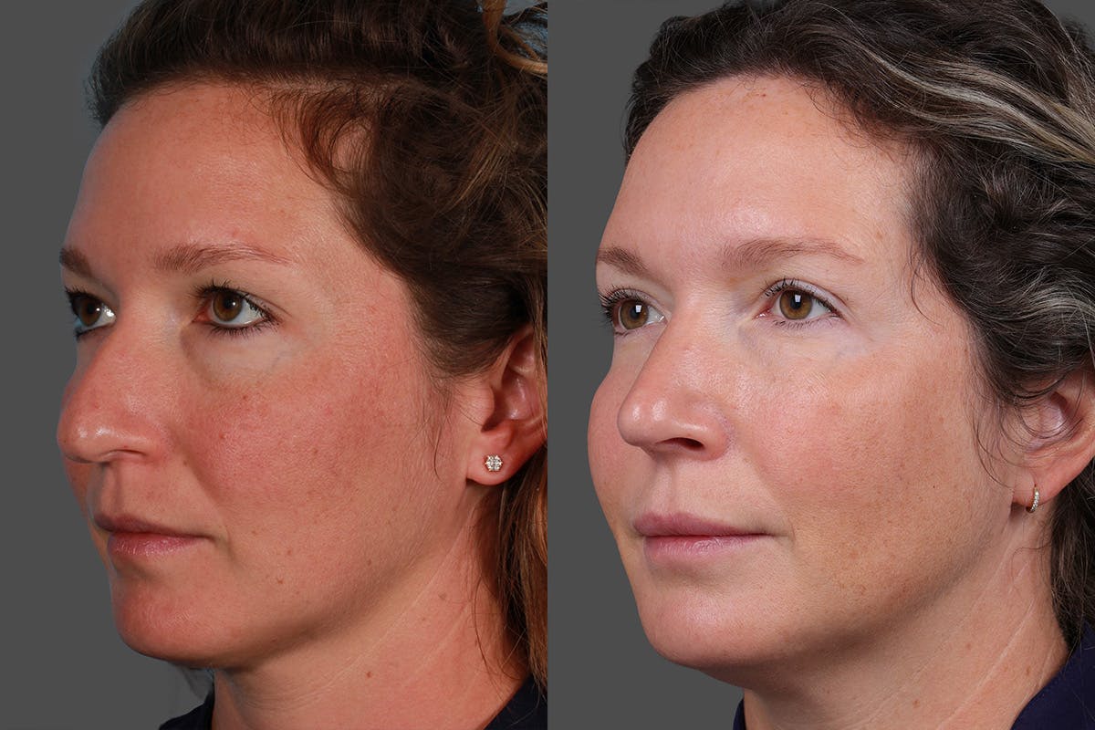 Eyelid Surgery (Blepharoplasty) Before & After Gallery - Patient 362020 - Image 4