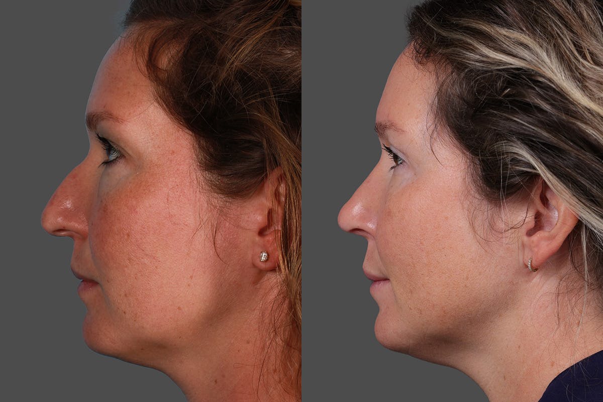 Eyelid Surgery (Blepharoplasty) Before & After Gallery - Patient 362020 - Image 5