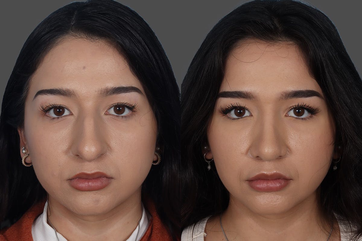 Rhinoplasty Before & After Gallery - Patient 916987 - Image 3