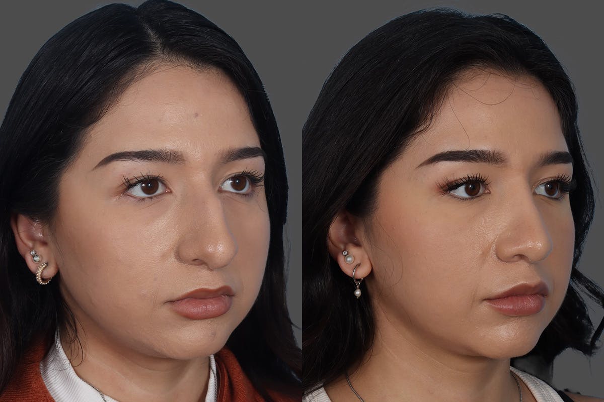 Rhinoplasty Before & After Gallery - Patient 916987 - Image 2