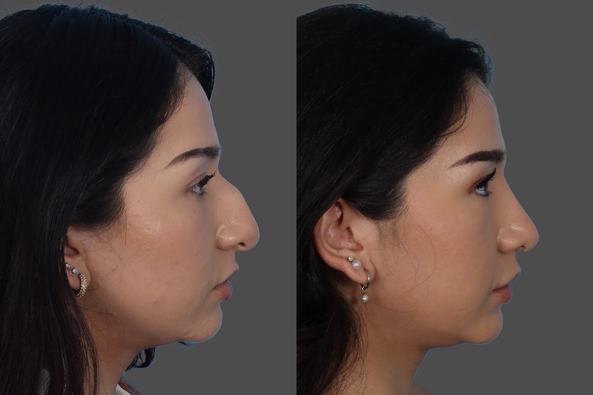 Rhinoplasty Before & After Gallery - Patient 916987 - Image 1