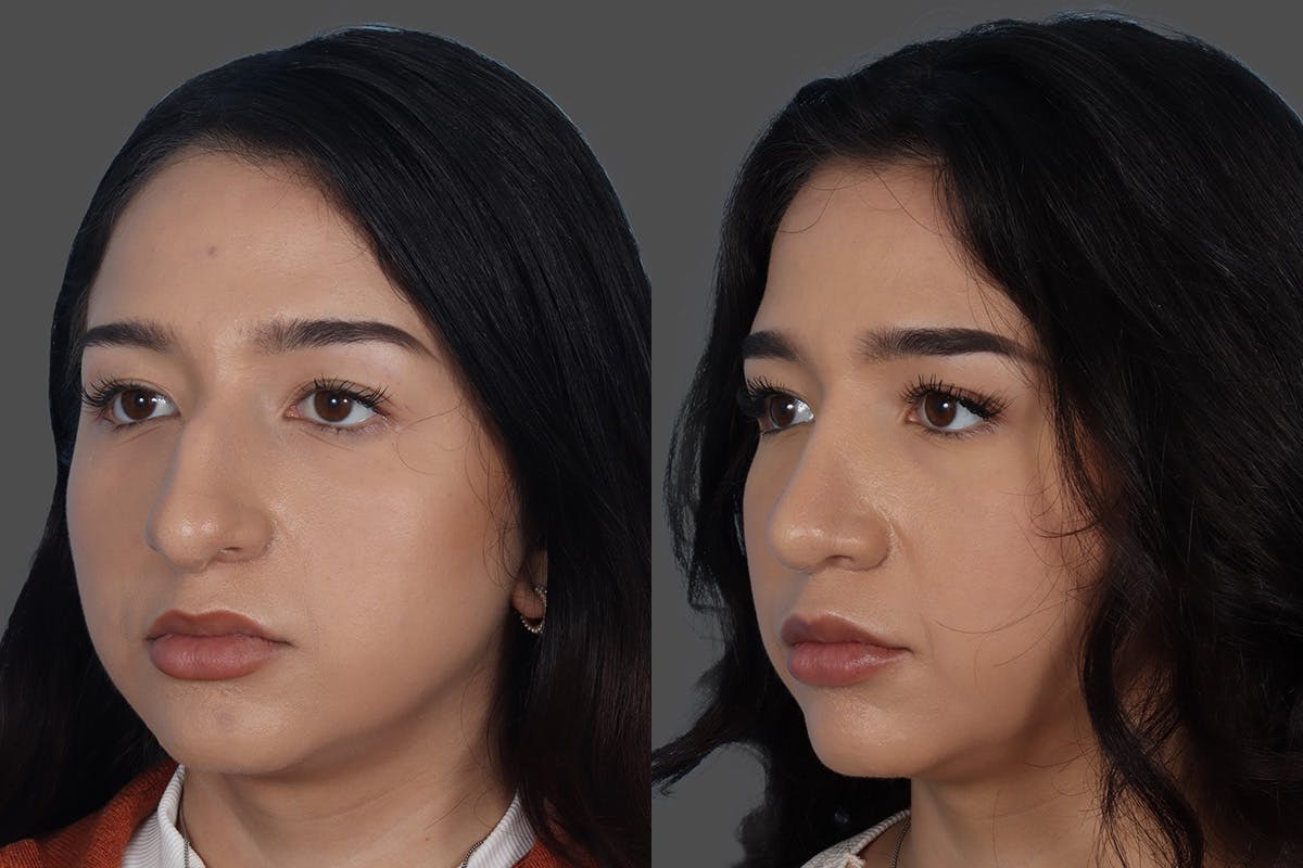 Rhinoplasty Before & After Gallery - Patient 916987 - Image 4