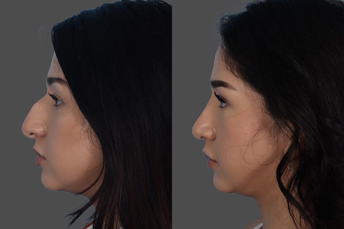 Rhinoplasty Before & After Gallery - Patient 916987 - Image 5