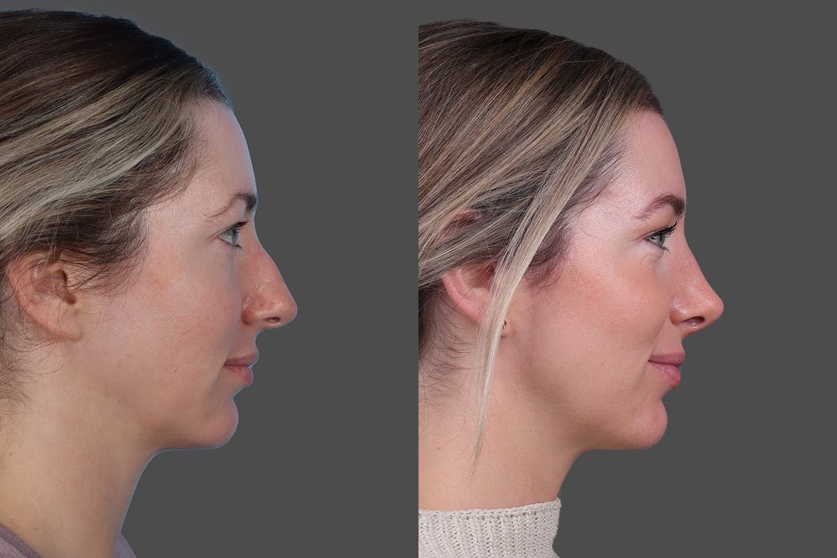 Rhinoplasty Before & After Gallery - Patient 619628 - Image 1
