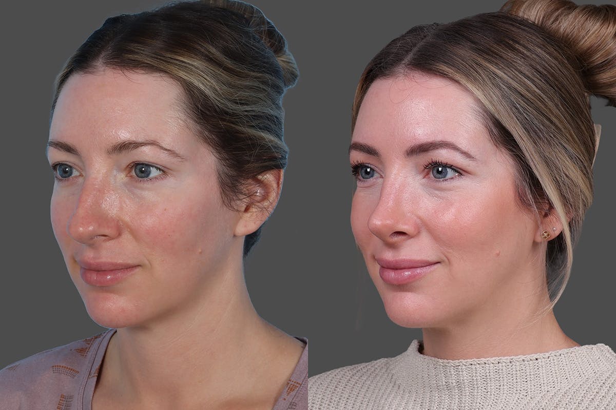 Rhinoplasty Before & After Gallery - Patient 619628 - Image 4