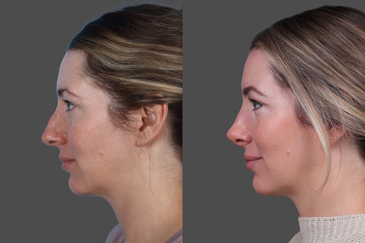 Rhinoplasty Before & After Gallery - Patient 619628 - Image 5