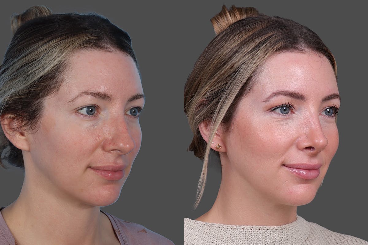 Rhinoplasty Before & After Gallery - Patient 619628 - Image 2