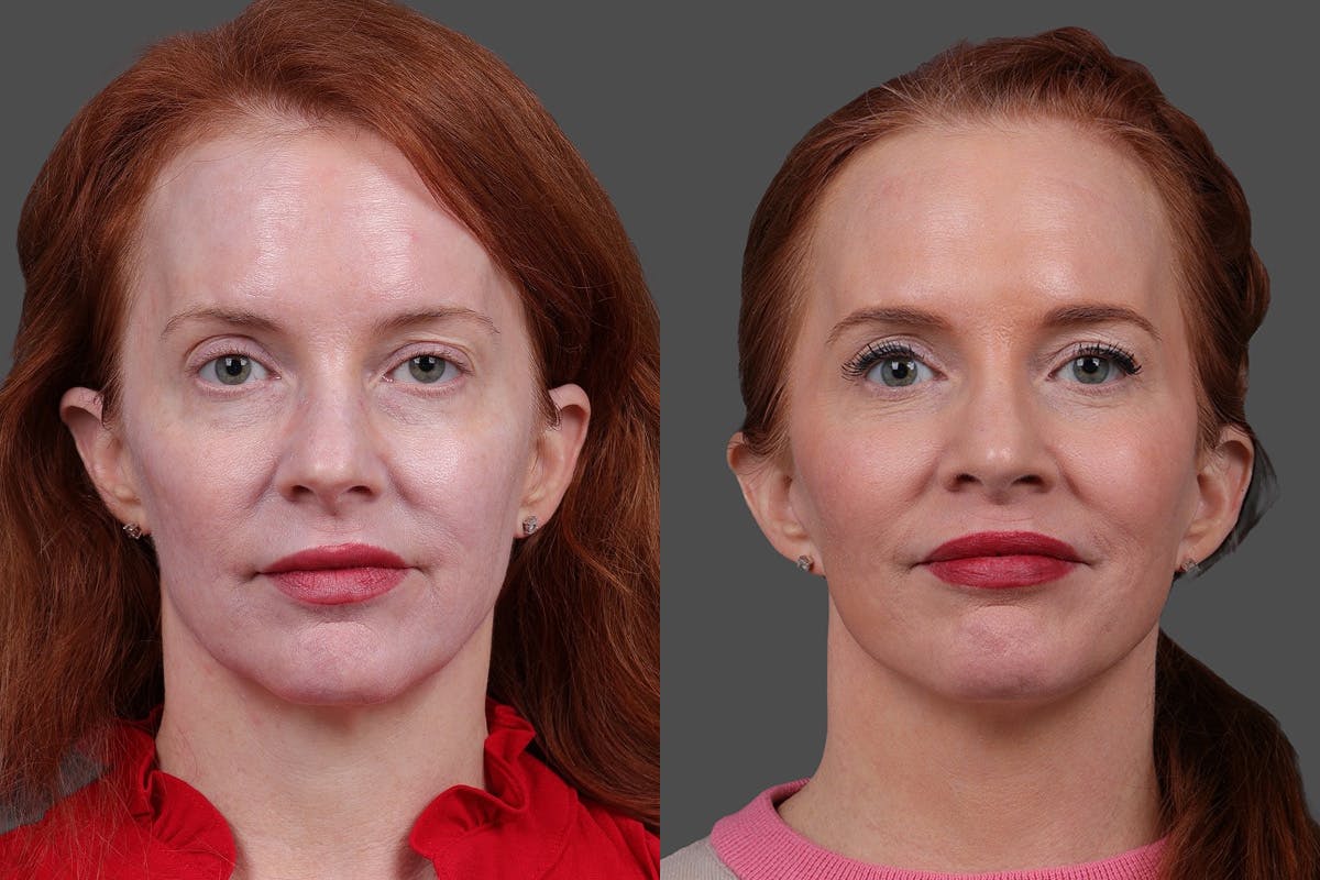 Limited Incision Facelift Before & After Gallery - Patient 363248 - Image 1