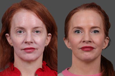 Limited Incision Facelift Before & After Gallery - Patient 363248 - Image 1