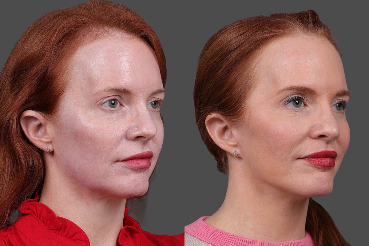 Limited Incision Facelift Before & After Gallery - Patient 363248 - Image 2