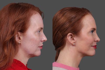 Rhinoplasty Before & After Gallery - Patient 408210 - Image 1