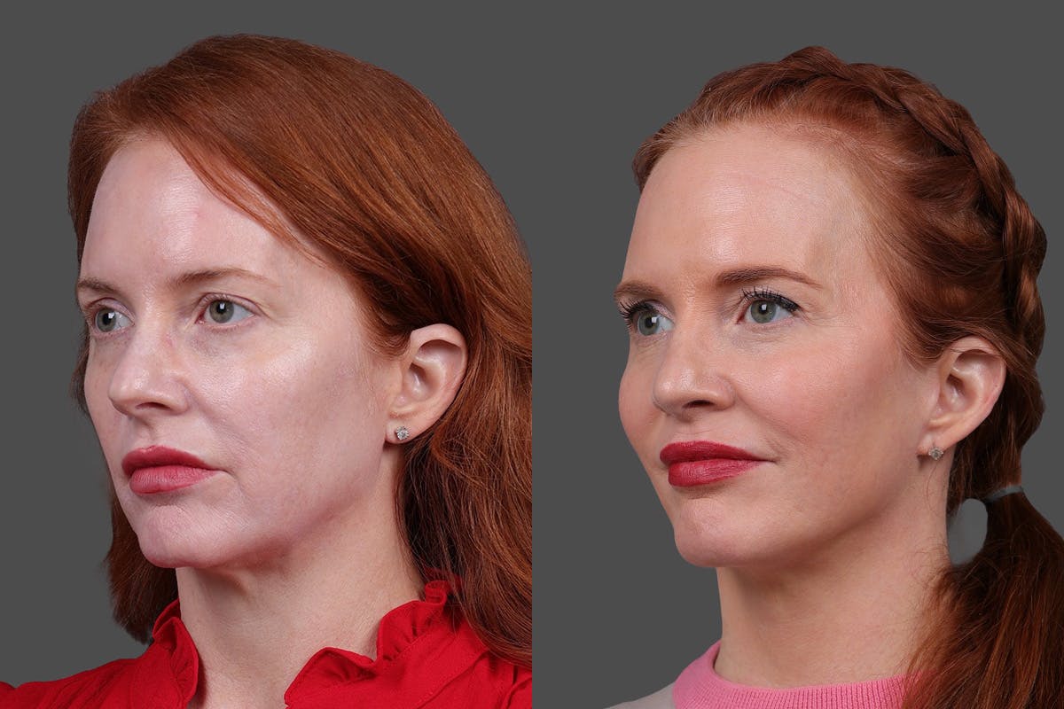 Limited Incision Facelift Before & After Gallery - Patient 363248 - Image 4