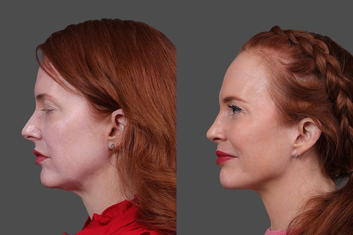 Limited Incision Facelift Before & After Gallery - Patient 363248 - Image 5