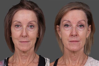 SkinVive Before & After Gallery - Patient 331817 - Image 1