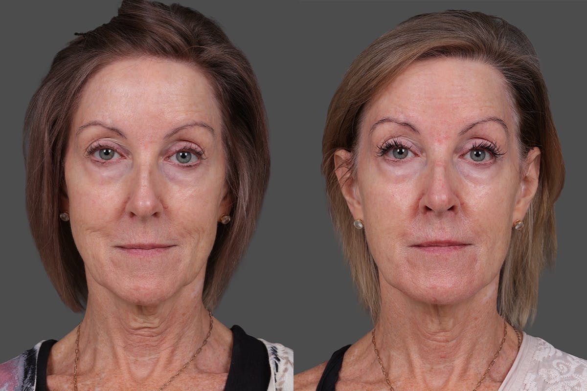 Revance RHA Before & After Gallery - Patient 592431 - Image 1