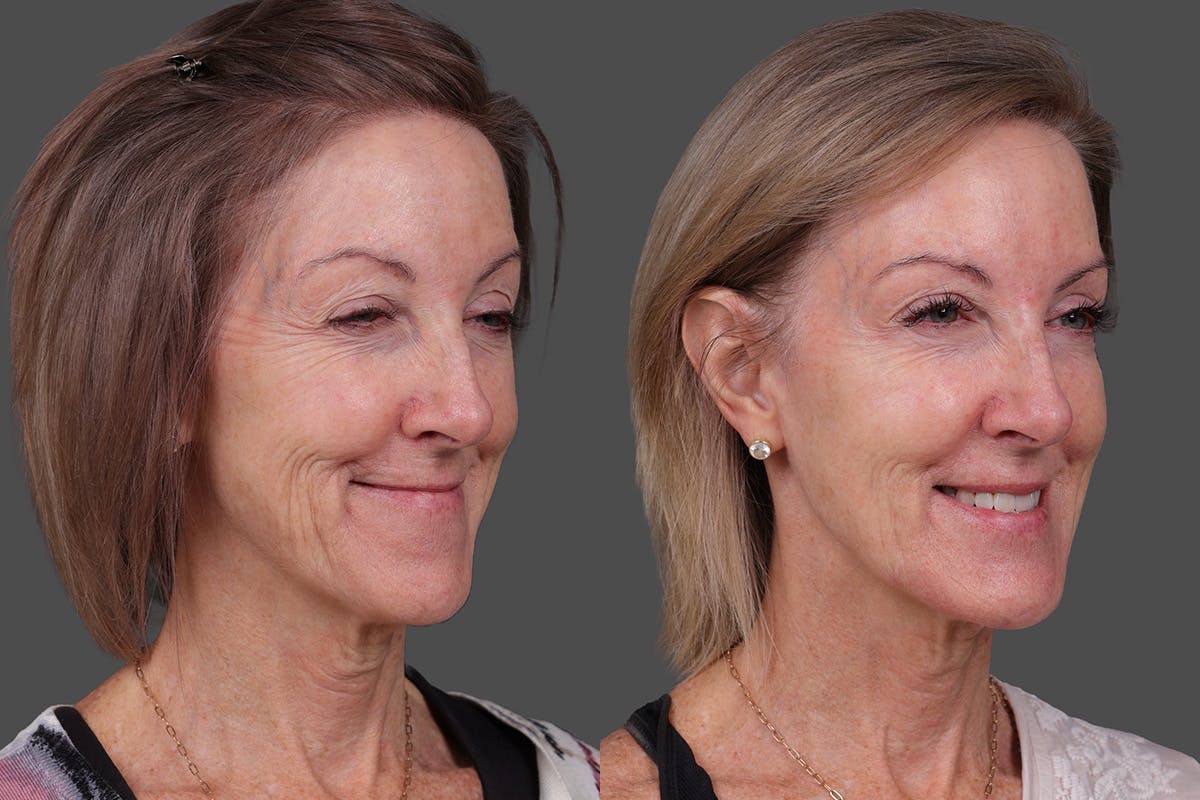 Revance RHA Before & After Gallery - Patient 592431 - Image 2