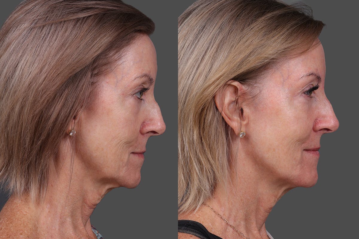 Revance RHA Before & After Gallery - Patient 592431 - Image 3