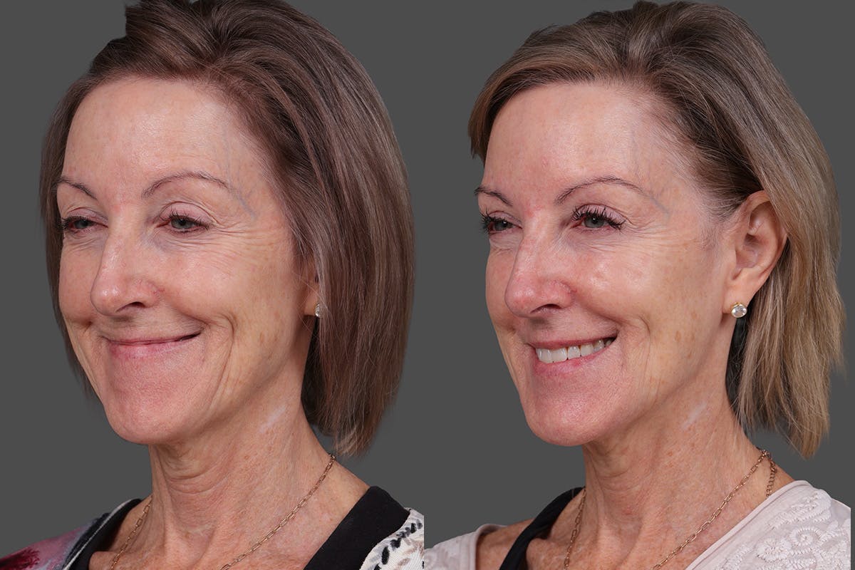 Revance RHA Before & After Gallery - Patient 592431 - Image 4