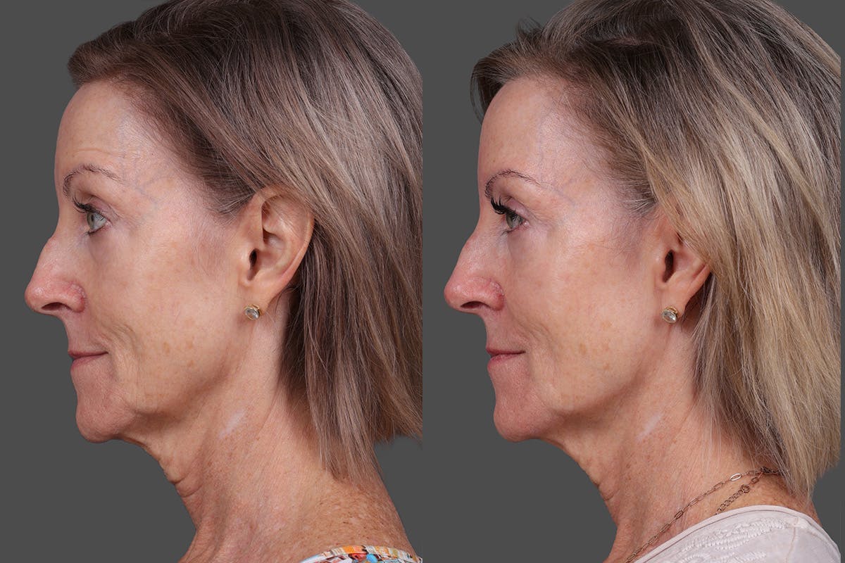 Revance RHA Before & After Gallery - Patient 592431 - Image 5