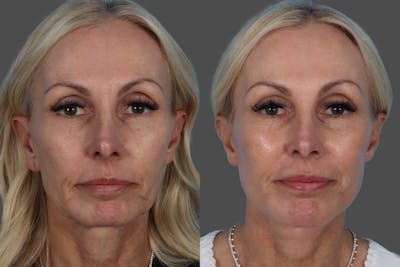 Chin and Cheek Augmentation Before & After Gallery - Patient 261597 - Image 1