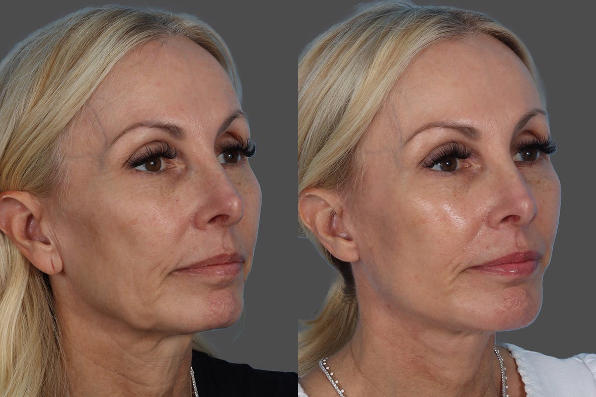 Chin and Cheek Augmentation Before & After Gallery - Patient 261597 - Image 2