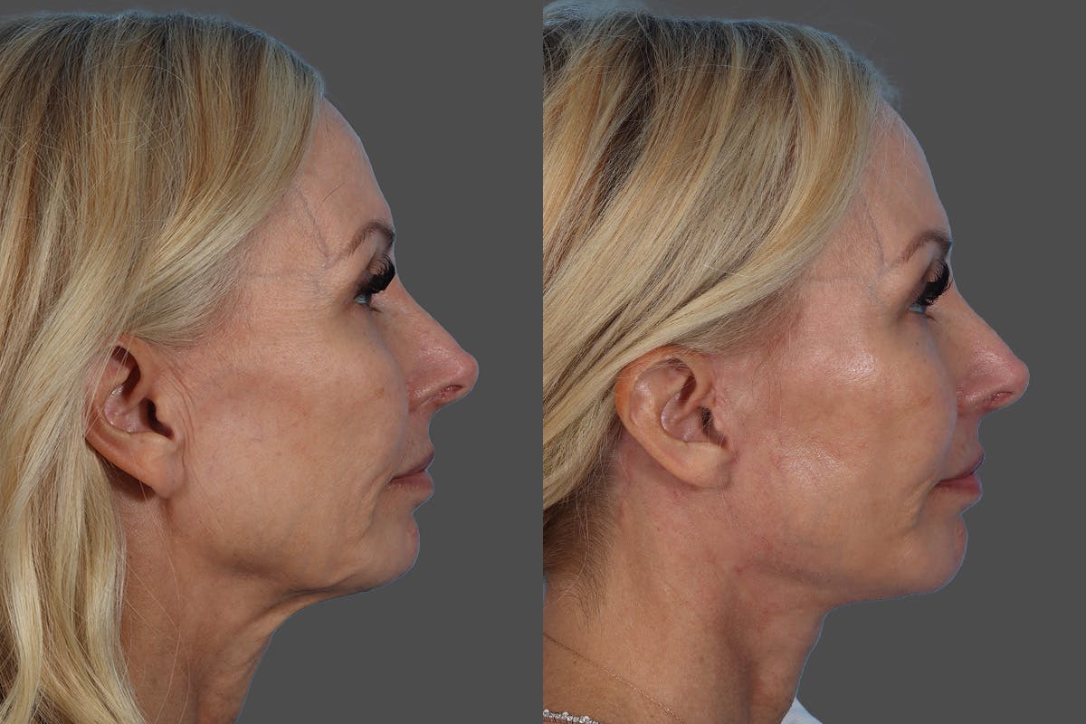 Chin and Cheek Augmentation Before & After Gallery - Patient 261597 - Image 3