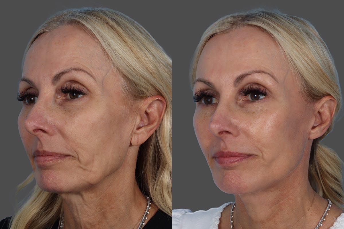 Chin and Cheek Augmentation Before & After Gallery - Patient 261597 - Image 4