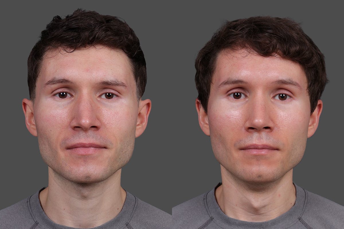 Rhinoplasty Before & After Gallery - Patient 397663 - Image 3