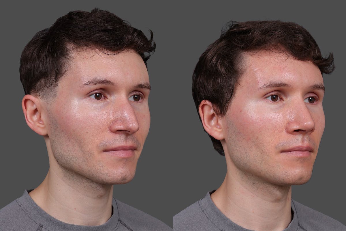 Rhinoplasty Before & After Gallery - Patient 397663 - Image 2