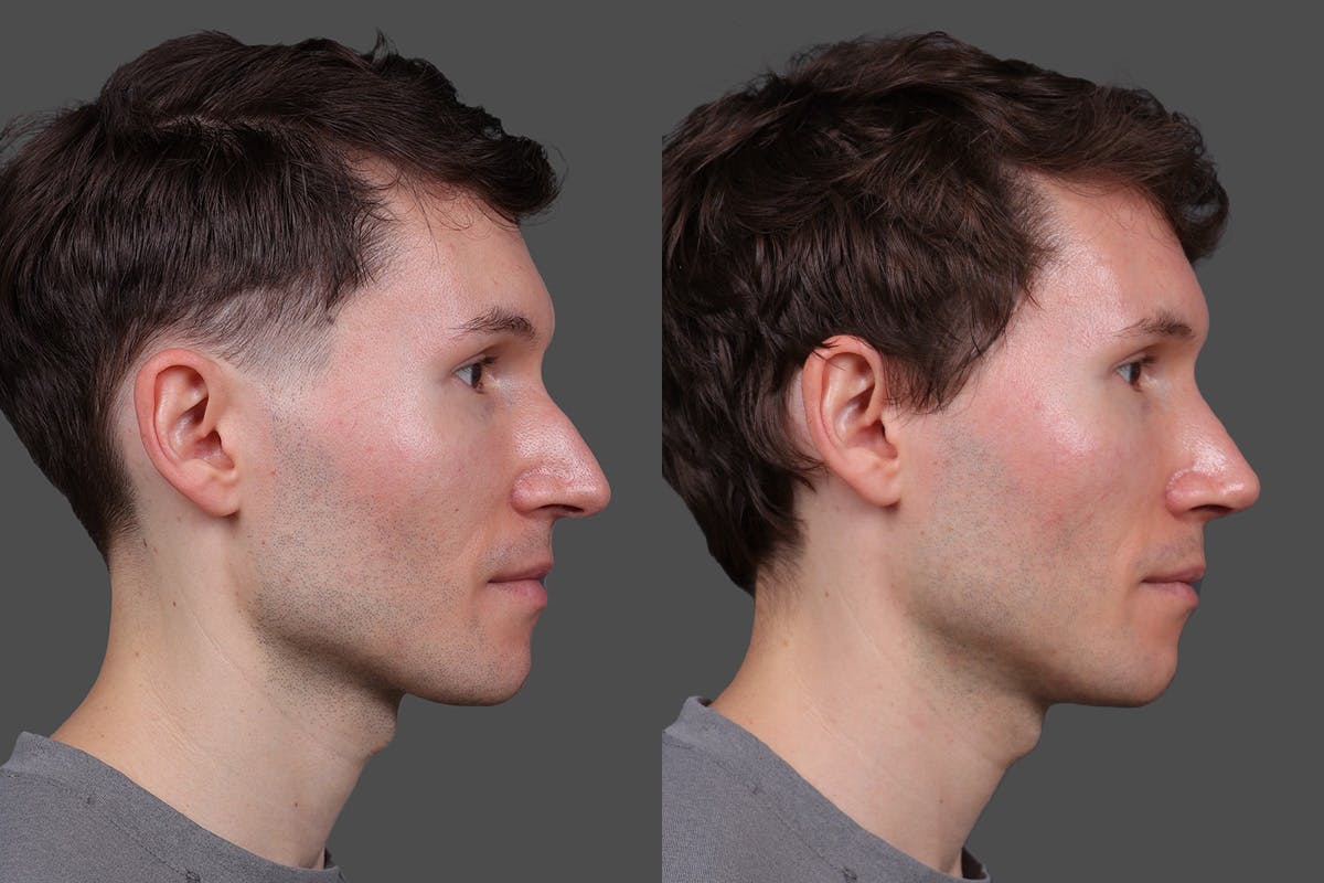 Rhinoplasty Before & After Gallery - Patient 397663 - Image 1