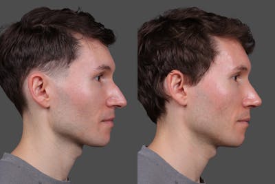 Rhinoplasty Before & After Gallery - Patient 397663 - Image 1