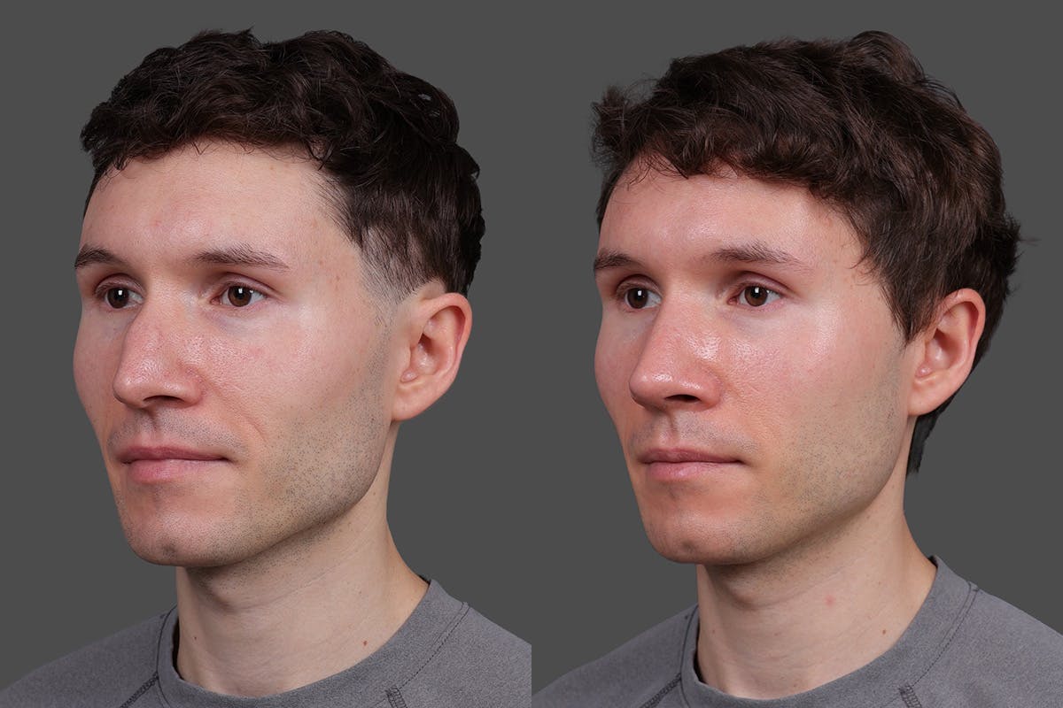 Rhinoplasty Before & After Gallery - Patient 397663 - Image 4