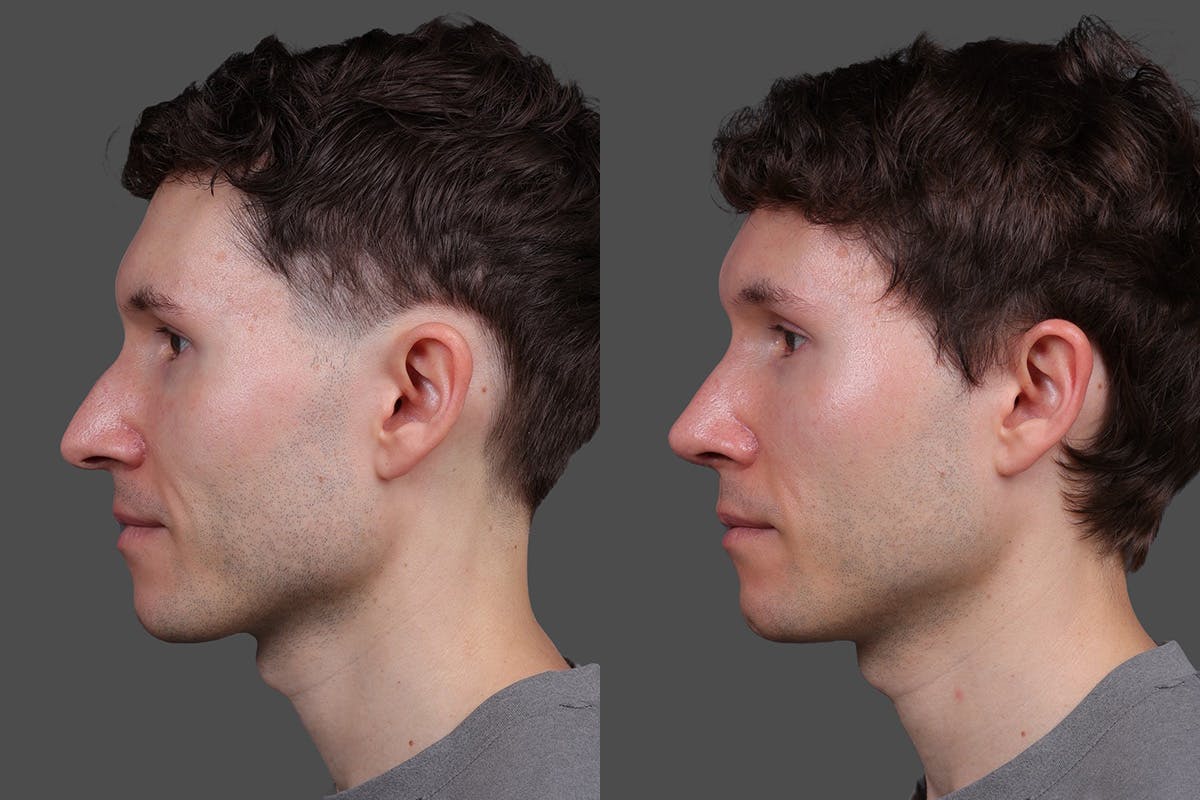 Rhinoplasty Before & After Gallery - Patient 397663 - Image 5