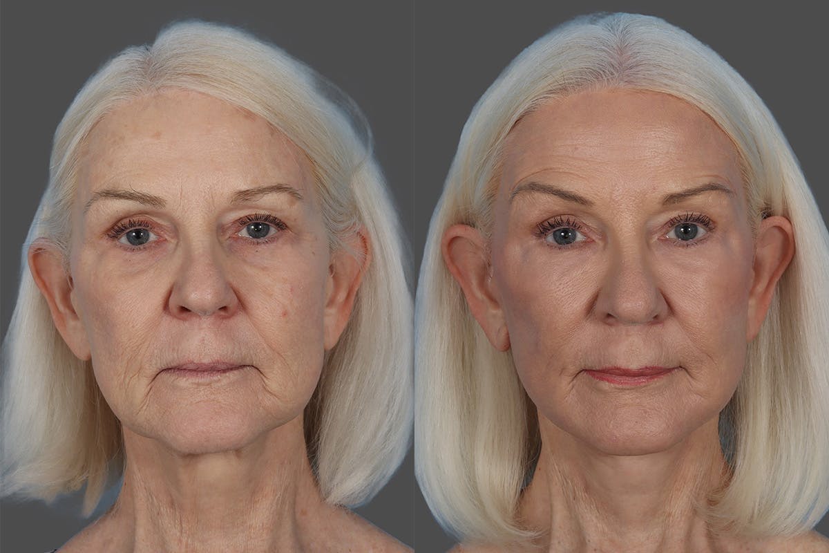 CO2 Fractional Laser Before & After Gallery - Patient 357015 - Image 1
