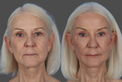 CO2 Fractional Laser Before & After Gallery - Patient 357015 - Image 1