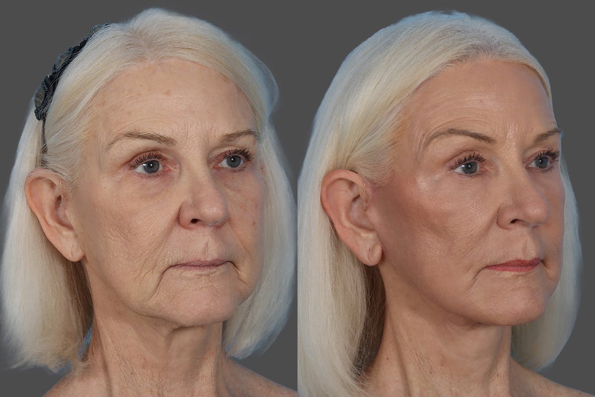 CO2 Fractional Laser Before & After Gallery - Patient 357015 - Image 2