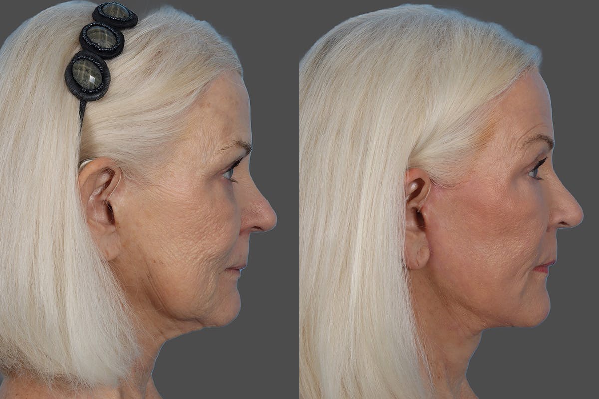 CO2 Fractional Laser Before & After Gallery - Patient 357015 - Image 3