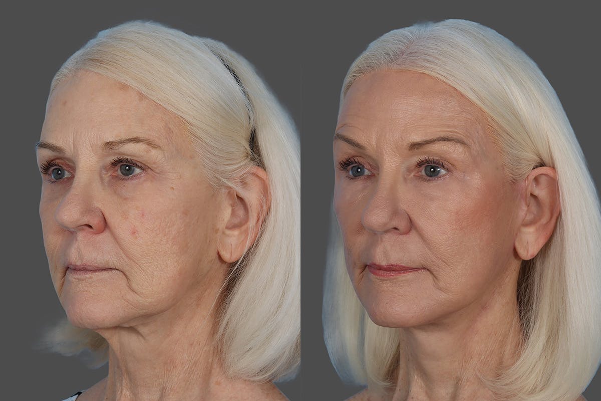CO2 Fractional Laser Before & After Gallery - Patient 357015 - Image 4
