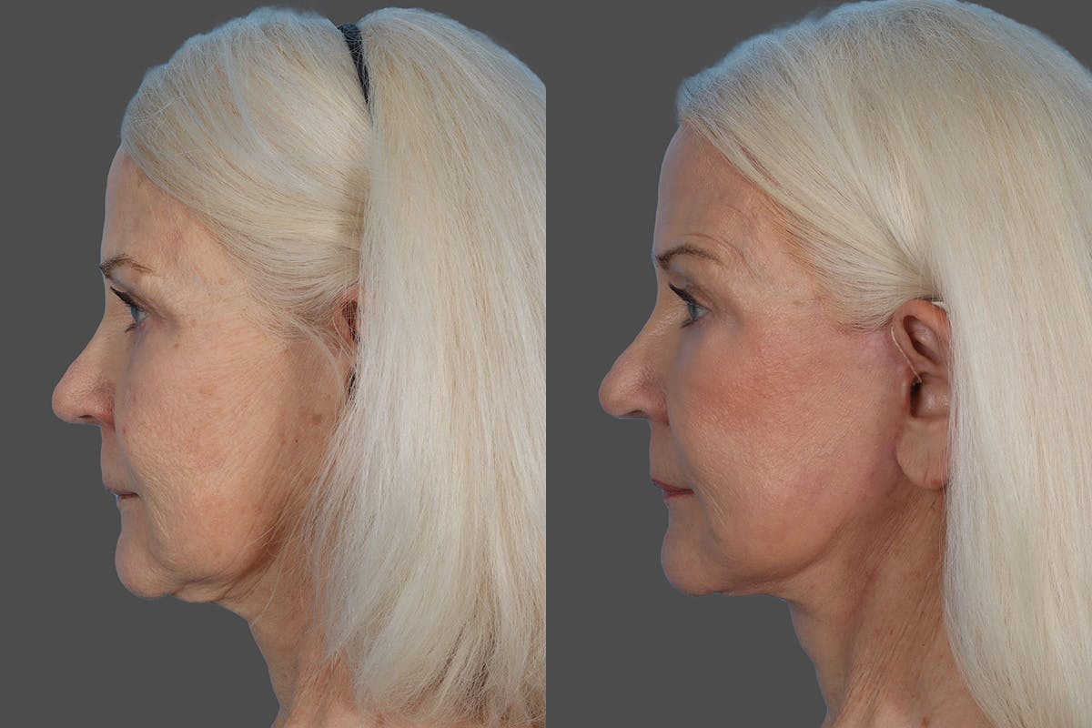CO2 Fractional Laser Before & After Gallery - Patient 357015 - Image 5
