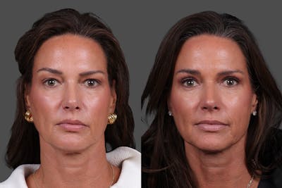 Eyelid Surgery (Blepharoplasty) Before & After Gallery - Patient 282688 - Image 1