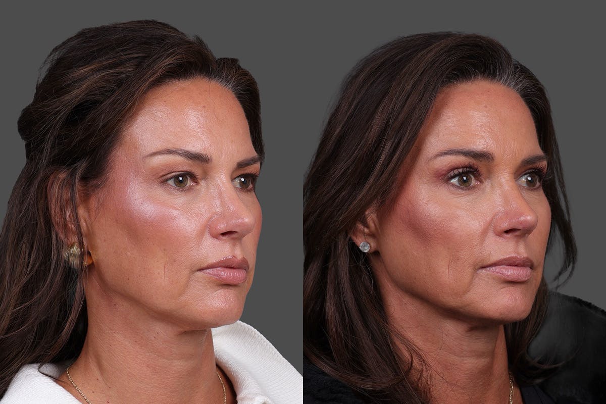 Eyelid Surgery (Blepharoplasty) Before & After Gallery - Patient 282688 - Image 2