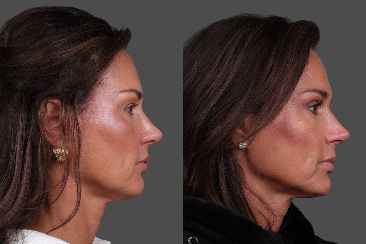 Eyelid Surgery (Blepharoplasty) Before & After Gallery - Patient 282688 - Image 3