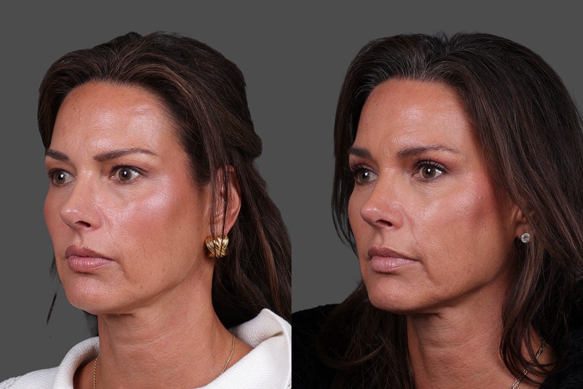 Eyelid Surgery (Blepharoplasty) Before & After Gallery - Patient 282688 - Image 4
