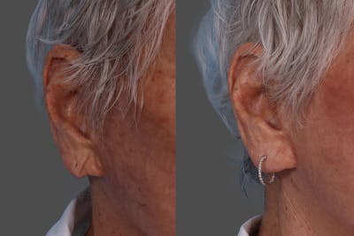 Revance RHA Before & After Gallery - Patient 566987 - Image 1