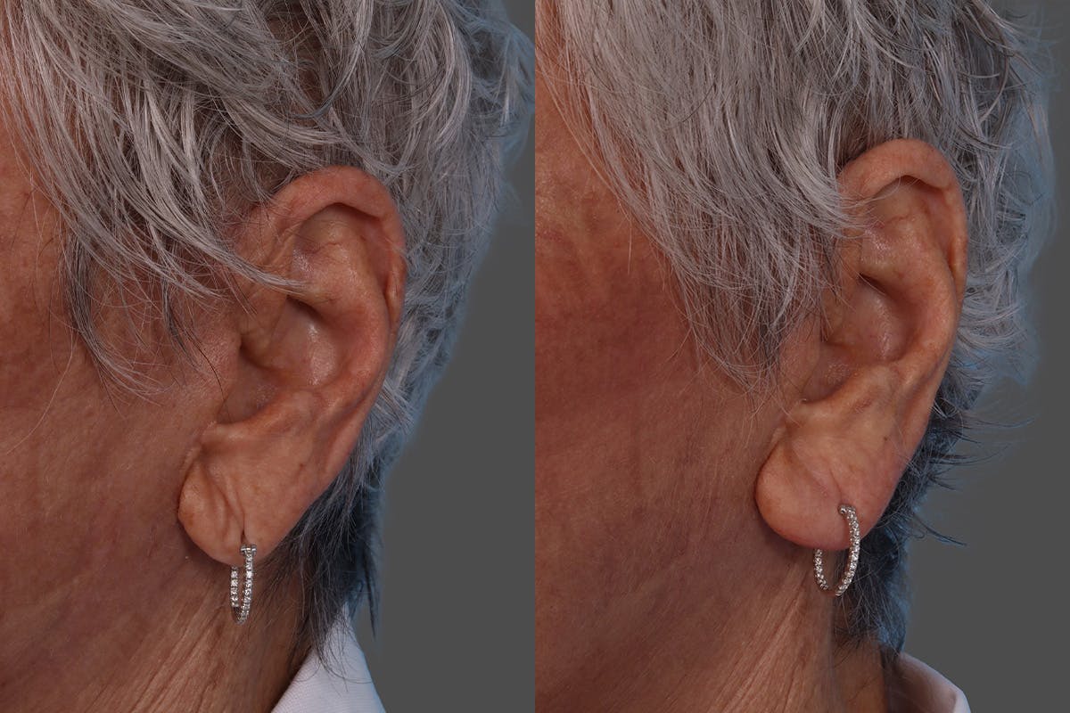 Revance RHA Before & After Gallery - Patient 566987 - Image 2