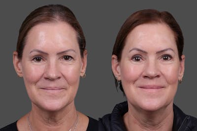 Eyelid Surgery (Blepharoplasty) Before & After Gallery - Patient 138195 - Image 1